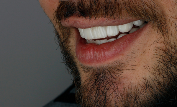 Smile Makeover Options For Teens